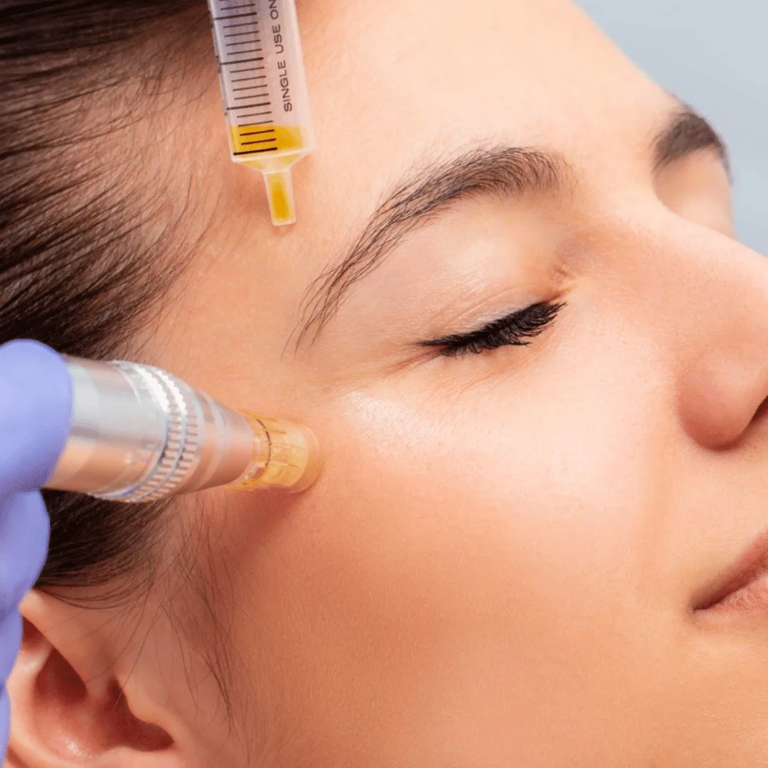 Skin needling treatment at Beauty Lounge St Kilda